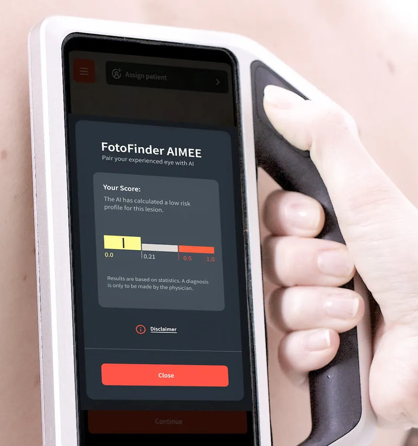 FotoFinder skeen — ručni dermatoskop s umjetnom inteligencijom tijekom pregleda madeža